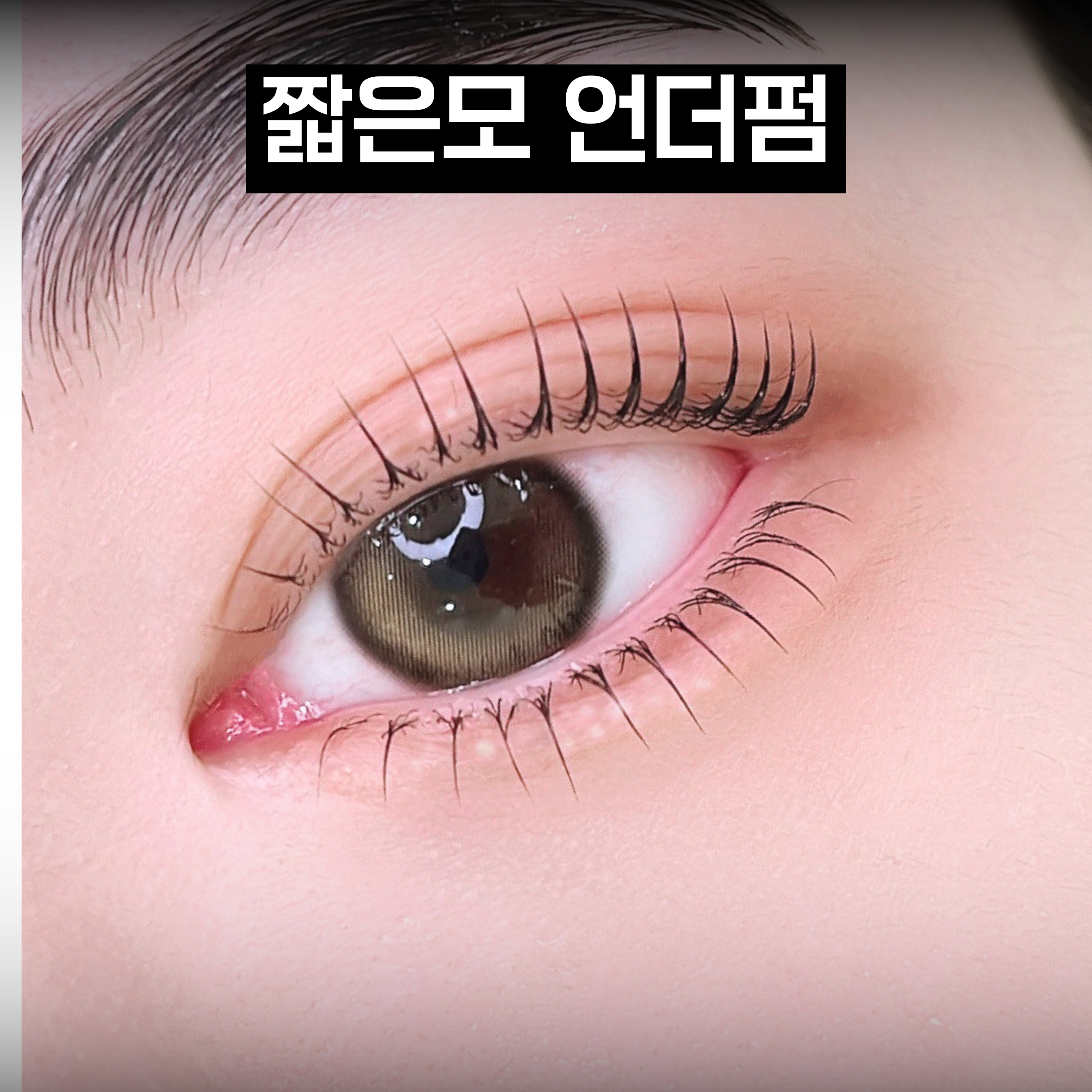 언더펌 시술 결과 6